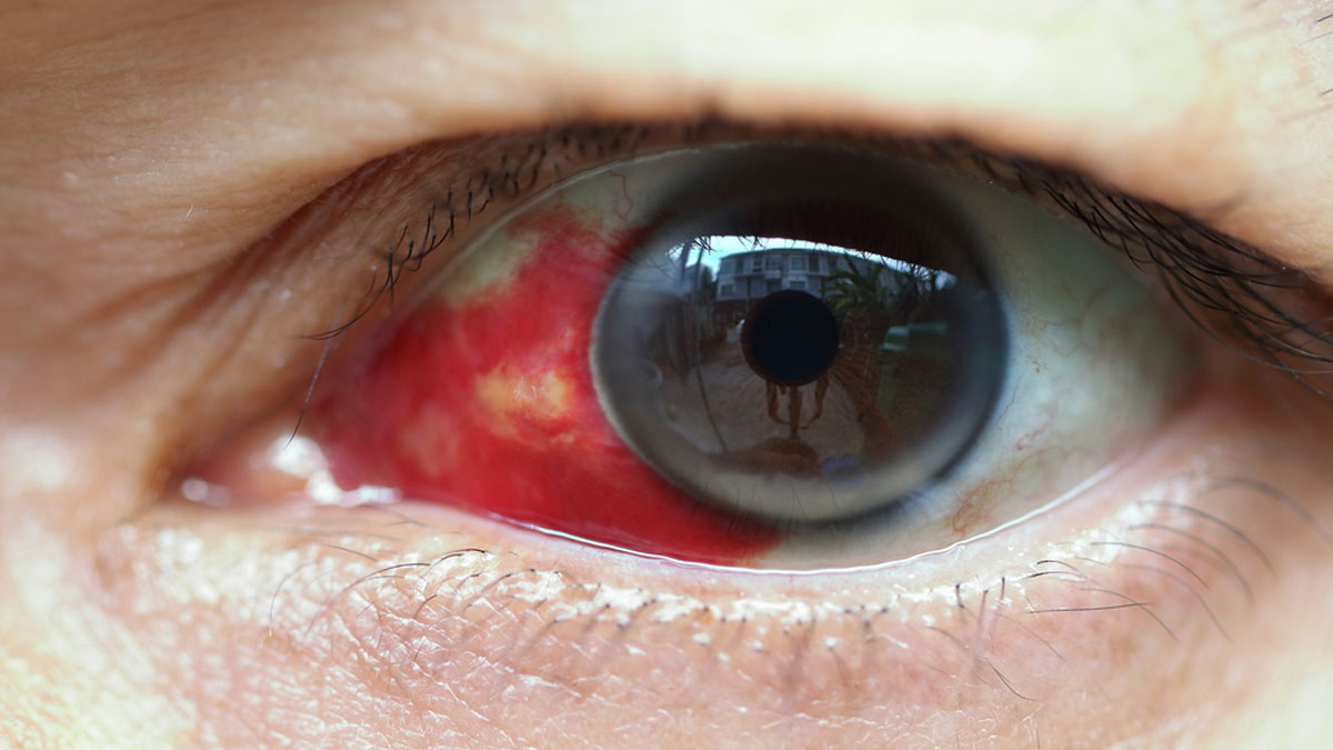Eye Bleeding Disease Which Kills 30% Of Its Patients: Expert Informs What Is Crimean Congo Haemorrhagic Fever